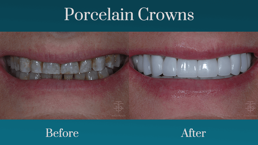 Smile makeover with porcelain 